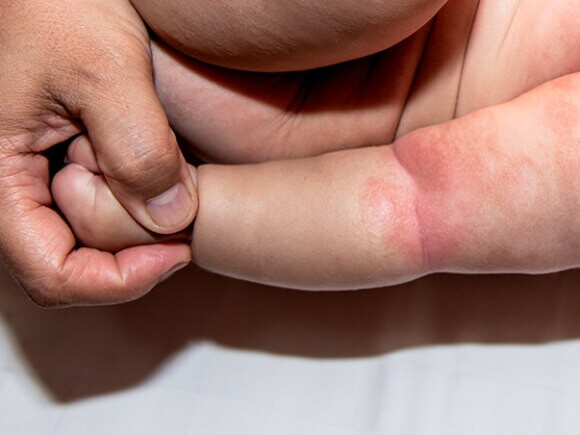 braço de bebê com manchas avermelhadas