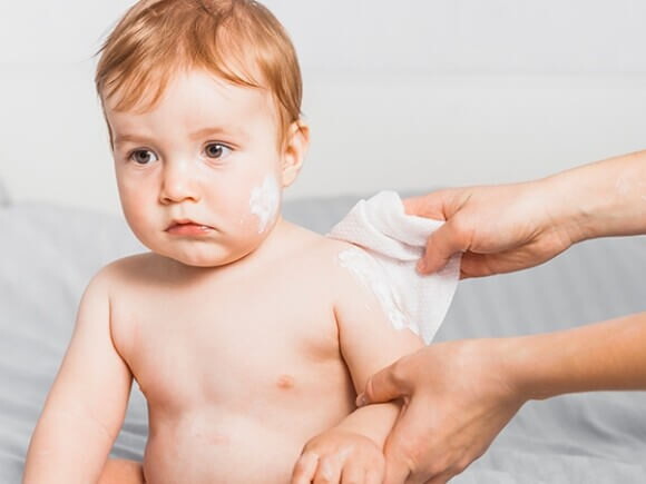 Imagem de mãe aplicando pomada em alergias na pele do bebê.