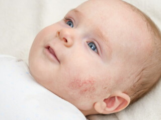 bebê com dermatite na bochecha