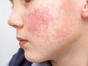 Foto de uma criança com alergia alimentar. Em destaque, está a bochecha do garoto com marcas bem vermelhas e irritação de pele..