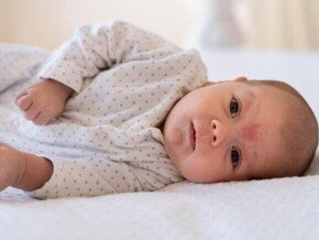 Um bebê deitado com uma mancha na testa que indica uma infecção fúngica