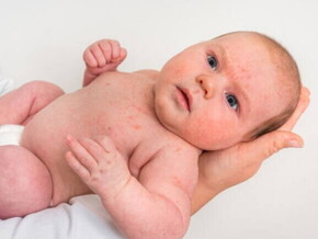 Um bebê com diversas manchinhas vermelhas espalhadas pelo corpo, sendo segurado nos braços de uma pessoa. Um bebê com diversas manchinhas vermelhas espalhadas pelo corpo, sendo segurado nos braços de uma pessoa.