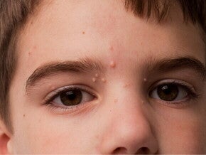 Close-up do rosto de uma criança, com múltiplas pequenas protuberâncias de cor clara, possivelmente lesões de molusco contagioso, visíveis na testa e nas pálpebras.