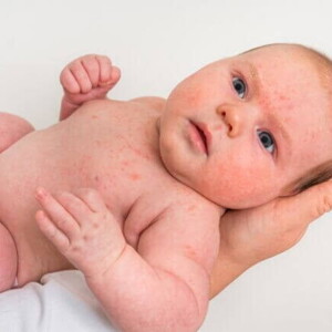 Um bebê com diversas manchinhas vermelhas espalhadas pelo corpo, sendo segurado nos braços de uma pessoa. Um bebê com diversas manchinhas vermelhas espalhadas pelo corpo, sendo segurado nos braços de uma pessoa.