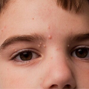 Close-up do rosto de uma criança, com múltiplas pequenas protuberâncias de cor clara, possivelmente lesões de molusco contagioso, visíveis na testa e nas pálpebras.