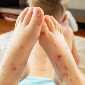 Criança deitada em um tapete com os pés cheios de feridas em destaque