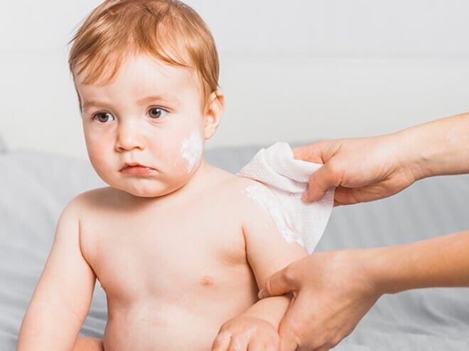 Mulher fazendo compressas e aplicando pomada em bebê com alergia do calor Mulher fazendo compressas e aplicando pomada em bebê com alergia do calor