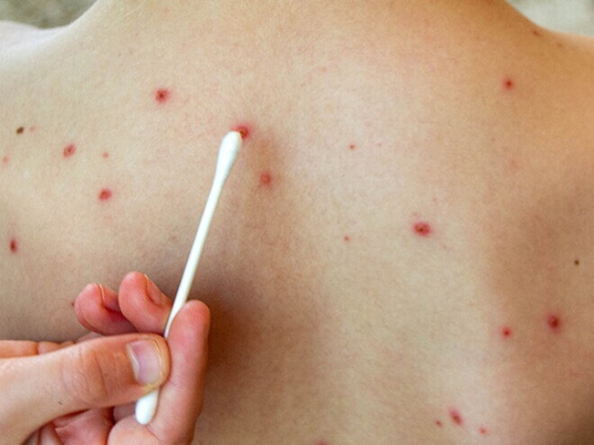 Médico examinando marcas de rubéola nas costas de uma criança. Médico examinando marcas de rubéola nas costas de uma criança.