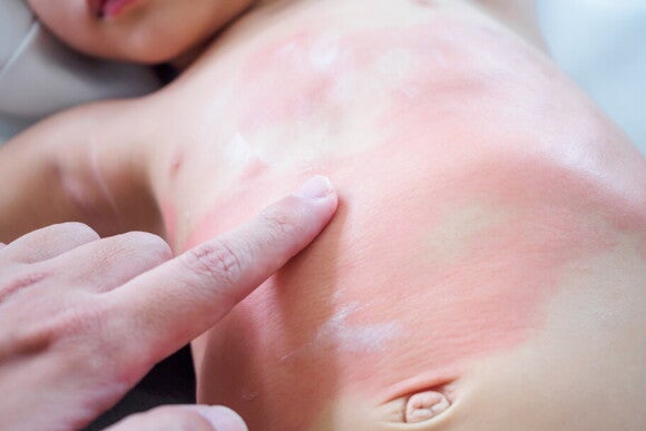 bebê com dermatite na barriga bebê com dermatite na barriga