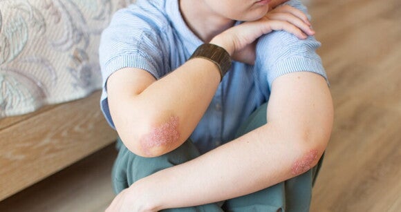 Criança sentada no chão com erupções cutâneas no braço causada pela escarlatina Criança sentada no chão com erupções cutâneas no braço causada pela escarlatina