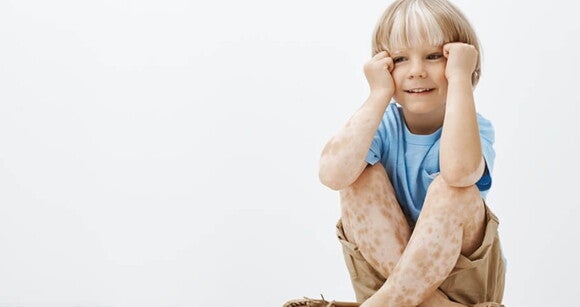 Foto de uma criança com manchas de vitiligo pelo corpo Foto de uma criança com manchas de vitiligo pelo corpo