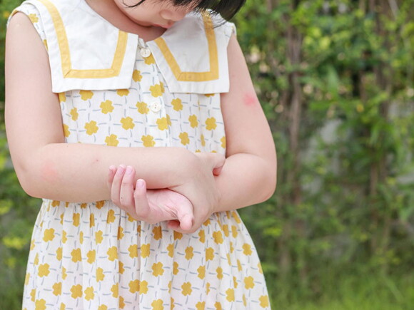 Imagem de menina em um vestido amarelo e branco com roséola infantil (erupção cutânea vermelha que aparece após a queda da temperatura) no braço esquerdo.