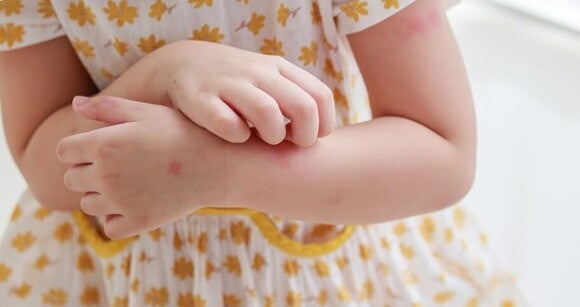 Imagem de menina pequena com alergia coçando o braço. Imagem de menina pequena com alergia coçando o braço.