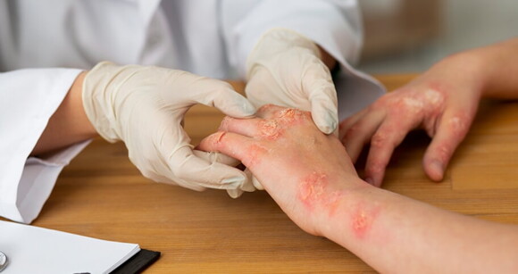 médico examinando mãos de paciente com erupções cutâneas médico examinando mãos de paciente com erupções cutâneas