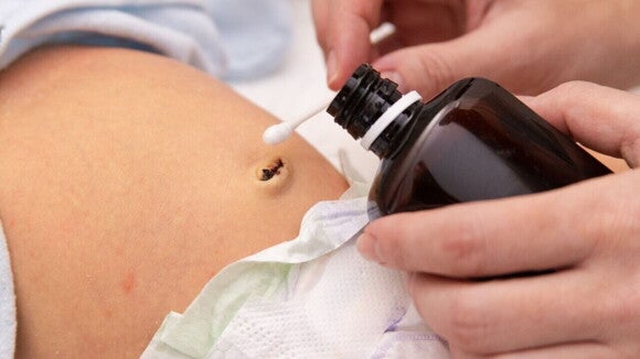Mão de adulto higienizando o umbigo de recém-nascido com cotonete e antisséptico, mostrando o cuidado com o coto umbilical do bebê. Mão de adulto higienizando o umbigo de recém-nascido com cotonete e antisséptico, mostrando o cuidado com o coto umbilical do bebê.